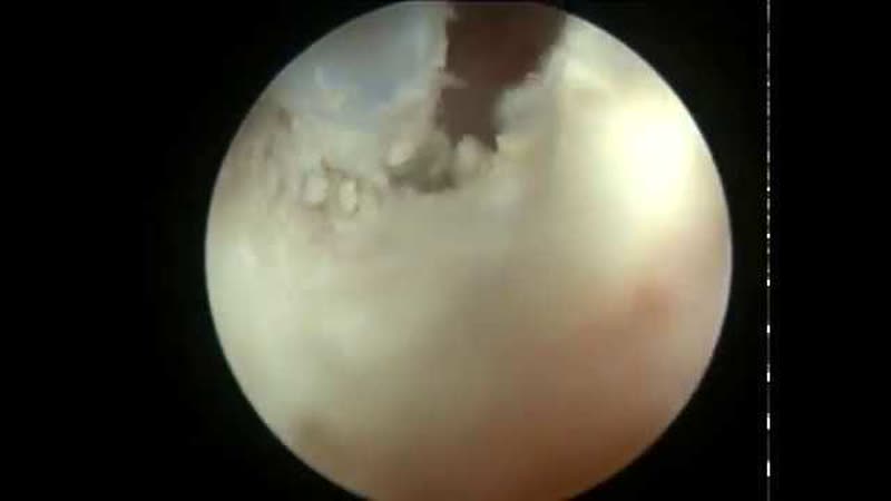 Ear wax cleaning in