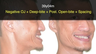 Primary Failure of EruptionChris Chang OrthoCC815