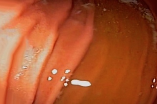 Gastroscopy