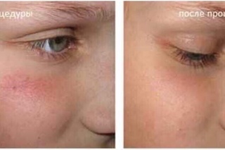 Смотрите, какая акция: удаление сосудистых дефектов кожи (фотокоагуляция) в медц